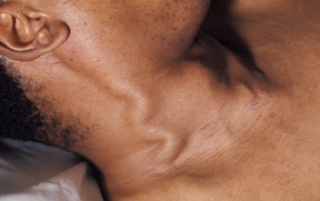 Patient with High JVP due to heart failure