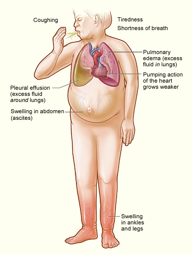 heart failure diagram